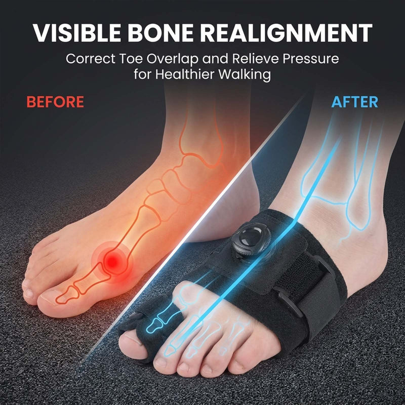 Adjustable Bunion Corrector
